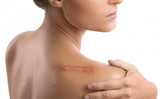 Top 5 mituri despre corectarea cicatricilor demontate de chirurgi