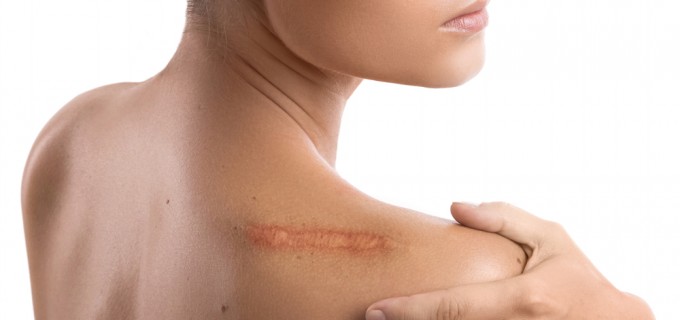 Top 5 mituri despre corectarea cicatricilor demontate de chirurgi