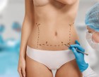 Corpul tău, regulile tale: Ghidul tău despre liposucție și abdominoplastie