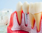 Implantul dentar are numeroase avantaje pentru pacienti. Care sunt acestea si care sunt pacientii pentru care nu este recomandat acest tratament stomatologic?