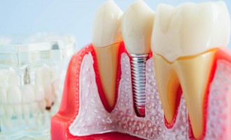 Implantul dentar are numeroase avantaje pentru pacienti. Care sunt acestea si care sunt pacientii pentru care nu este recomandat acest tratament stomatologic?