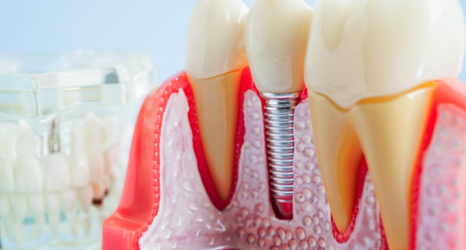 Implantul dentar are numeroase avantaje pentru pacienti. Care sunt acestea si care sunt pacientii pentru care nu este recomandat acest tratament stomatologic?