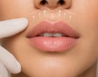 Lip Lift: ce este intervenția care poate modifica proporțiile buzei superioare