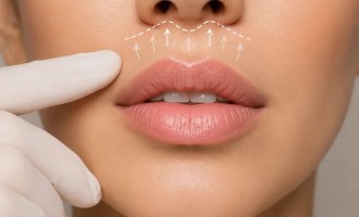 Lip Lift: ce este intervenția care poate modifica proporțiile buzei superioare
