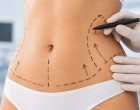 Ce Rezultate Poți Obține Prin Liposucție