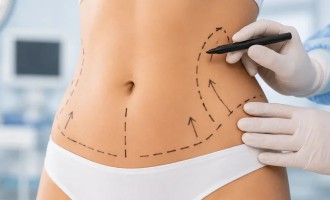 Ce Rezultate Poți Obține Prin Liposucție