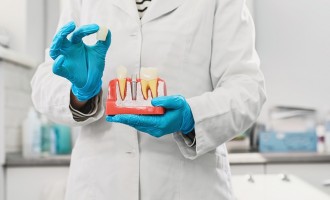 Ce este un bont protetic pentru implant dentar și cum îl alegi corect? Ghid explicat de specialiști