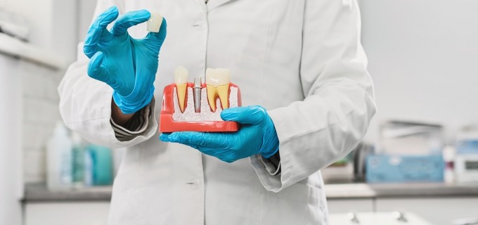 Ce este un bont protetic pentru implant dentar și cum îl alegi corect? Ghid explicat de specialiști