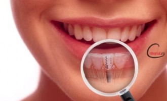Ce este implantul dentar si care sunt beneficiile acestuia?