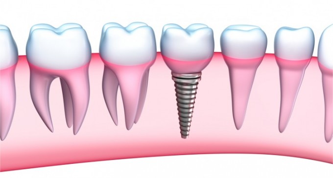 De ce este un implant dentar Fast&Fixed solutia potrivita pentru tine?