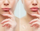 Injectare buze cu acid hialuronic