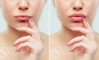 Injectare buze cu acid hialuronic