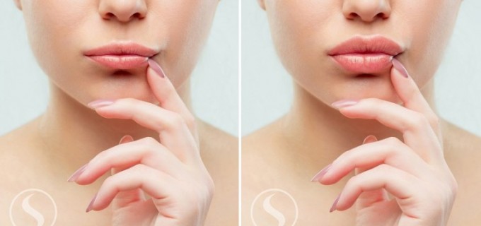 Injectare buze cu acid hialuronic